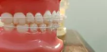 Soportes anda ortodoncia alambre estético 