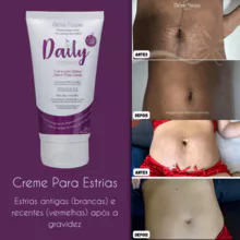 Daily Cream Treatment for Stretch Marks Michelle Marques