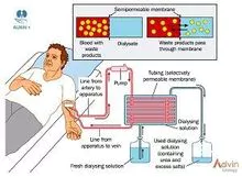 血液透析干粉