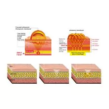 便携式除皱护肤Hifu机器皮肤收紧抗衰老面部提升