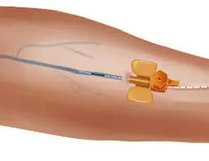 Radial Tip Surgical Laser Fibers